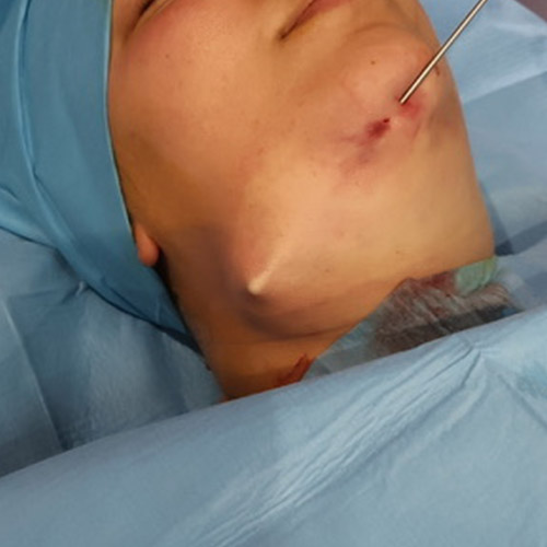 Lifting del collo, procedura chirurgica dal terzo inferiore del volto